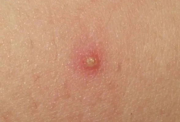 Mupirocin Mupirocin